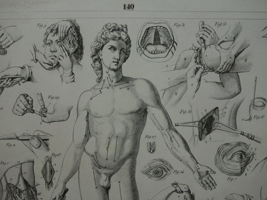 Oude anatomie prent over chirurgie originele antieke print operaties instrumenten chirurg anatomische prenten