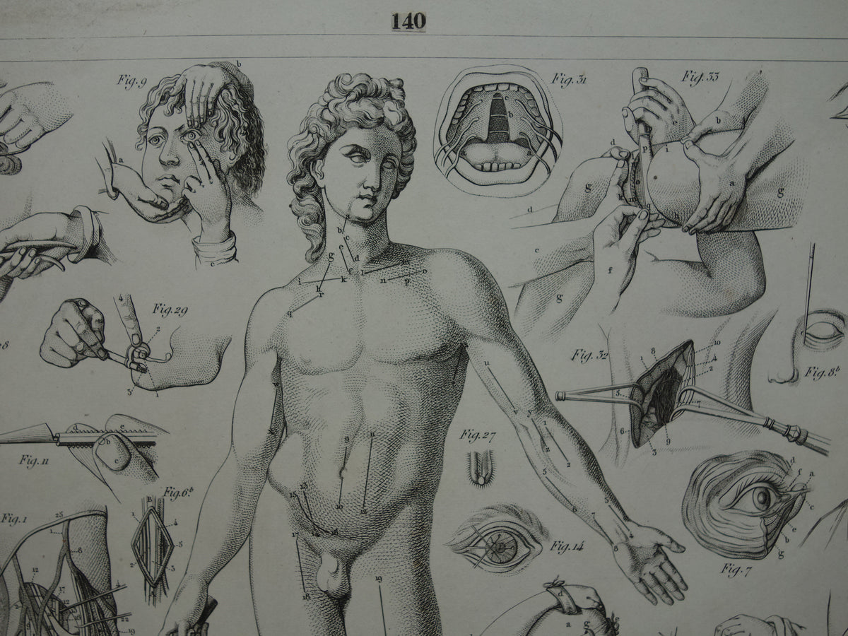 Oude anatomie prent over chirurgie originele antieke print operaties instrumenten chirurg anatomische prenten
