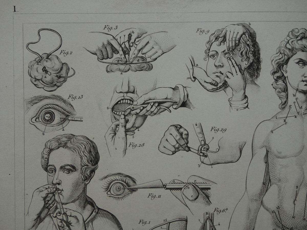 Oude anatomie prent over chirurgie originele antieke print operaties instrumenten chirurg anatomische prenten
