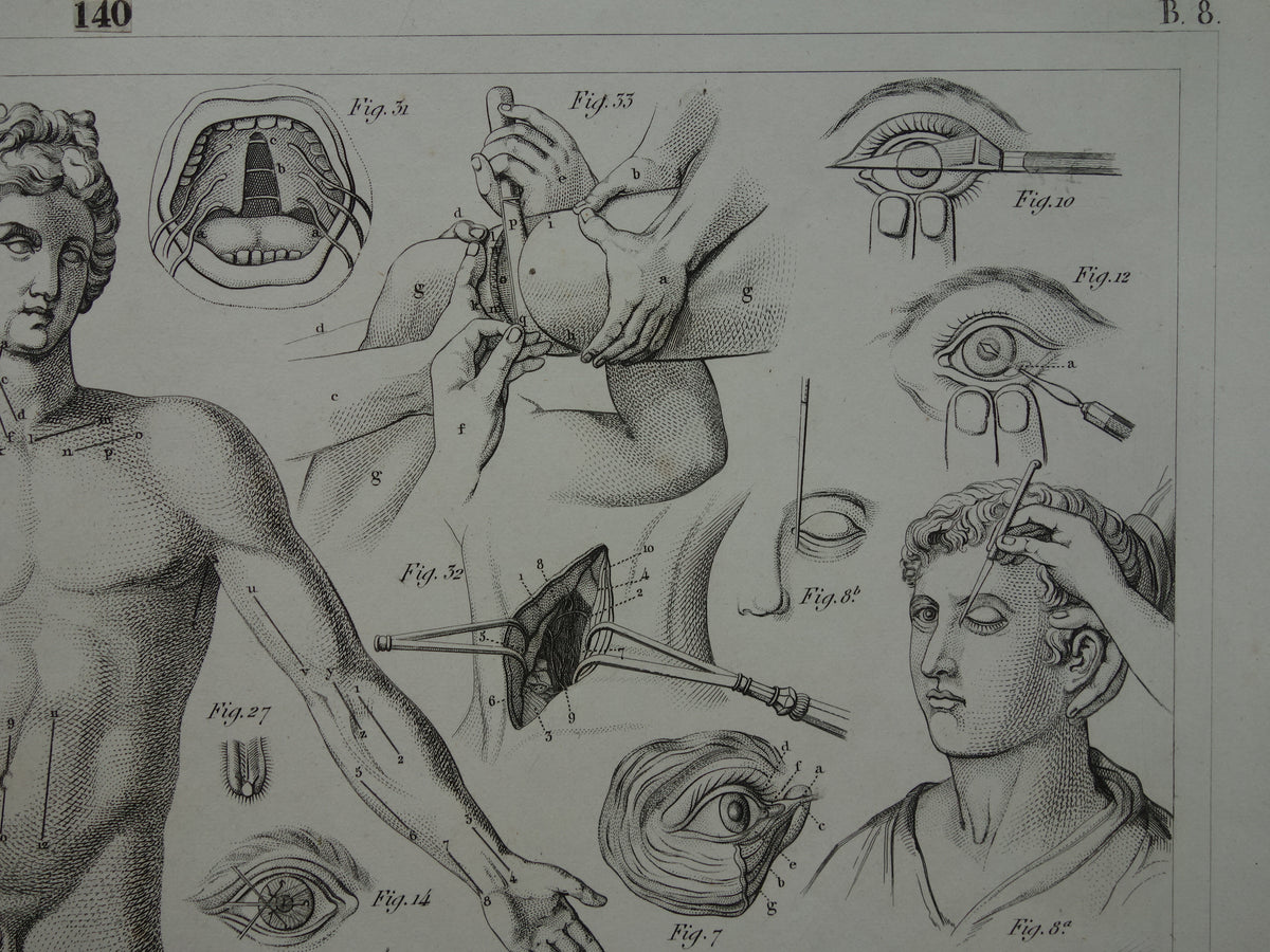 Oude anatomie prent over chirurgie originele antieke print operaties instrumenten chirurg anatomische prenten