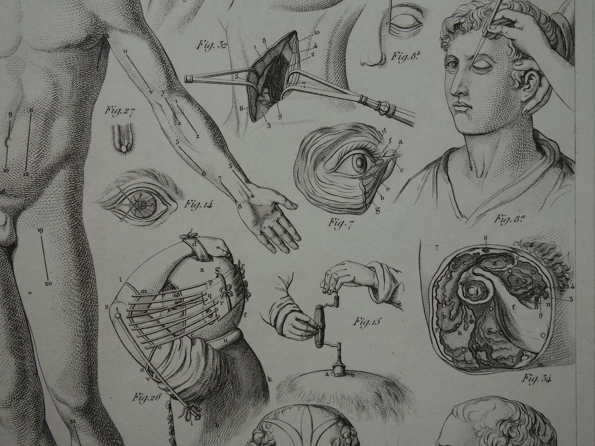 Oude anatomie prent over chirurgie originele antieke print operaties instrumenten chirurg anatomische prenten