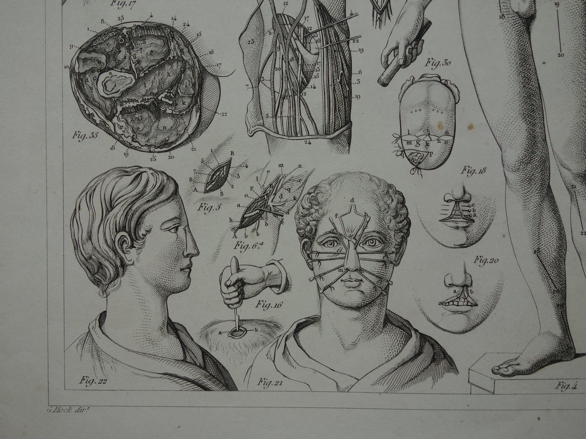 Oude anatomie prent over chirurgie originele antieke print operaties instrumenten chirurg anatomische prenten