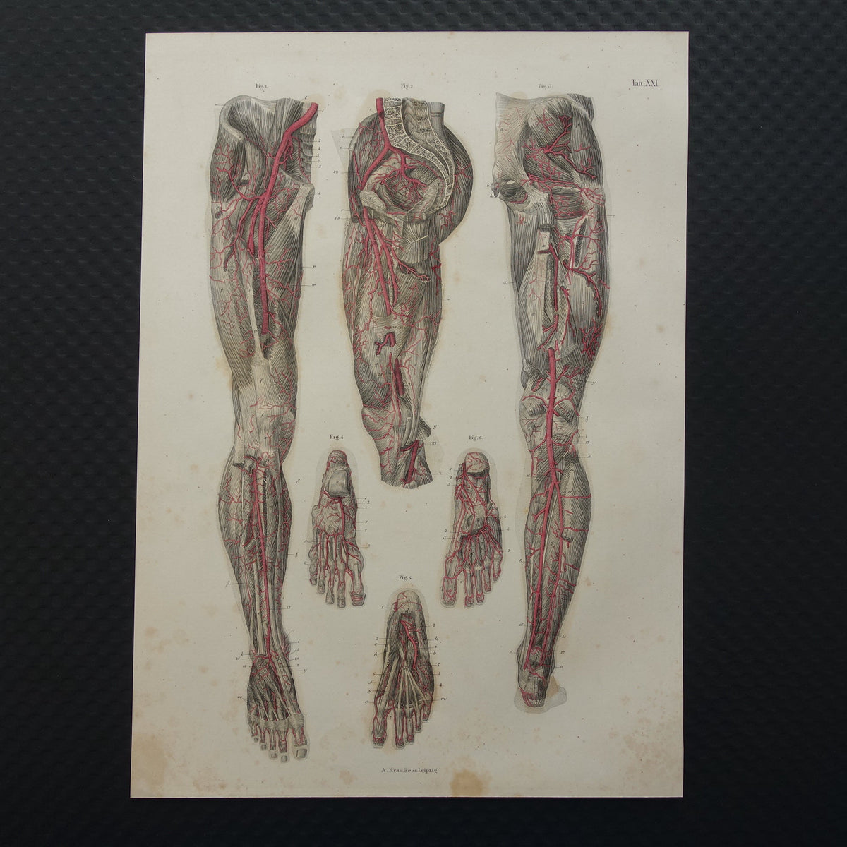 slagaders van het bekken, de benen en voeten anatomische gravure