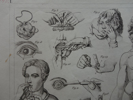 Oude anatomie prent over chirurgie originele antieke print operaties instrumenten chirurg anatomische prenten