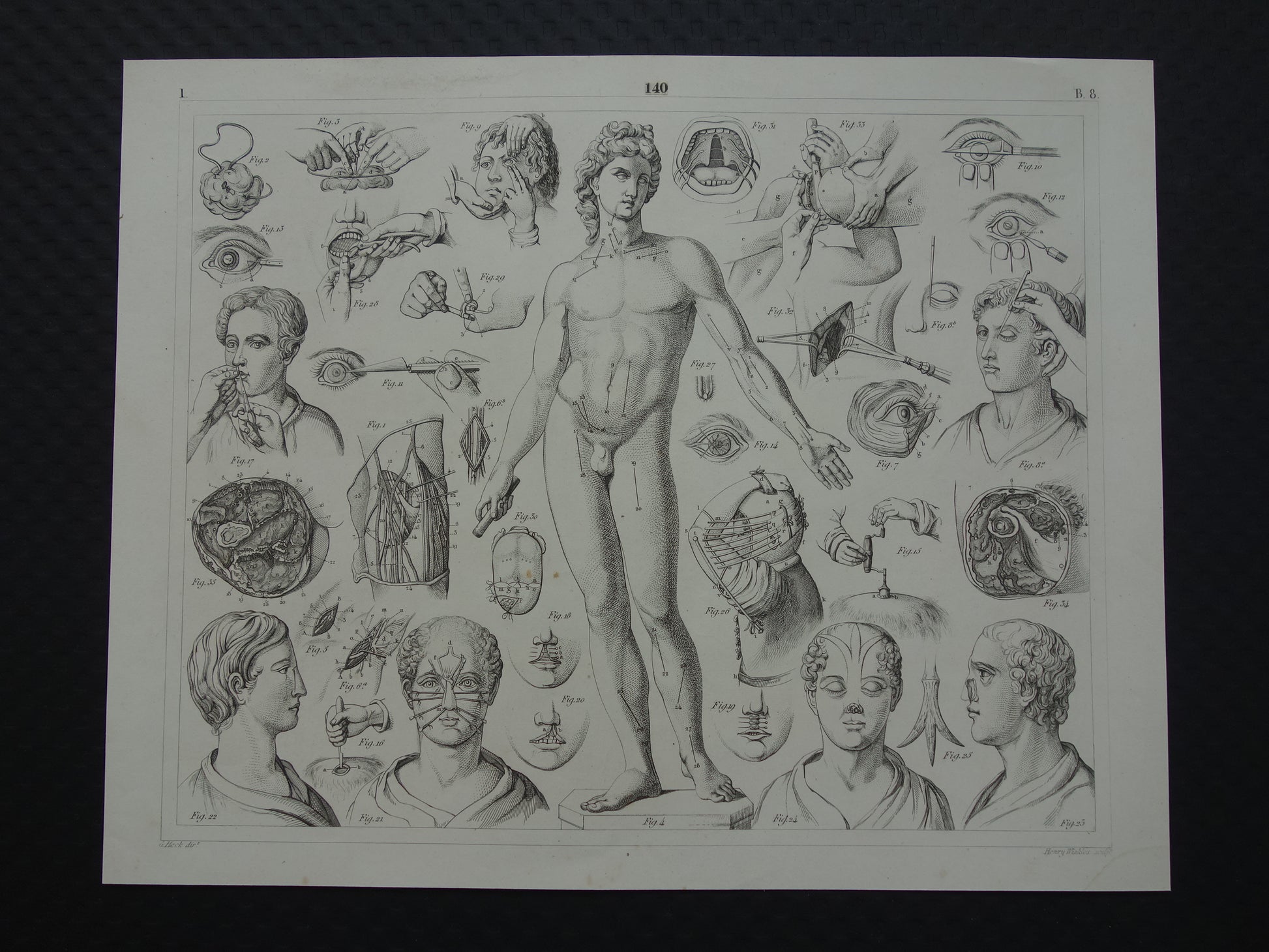 Oude anatomie prent over chirurgie originele antieke print operaties instrumenten chirurg anatomische prenten