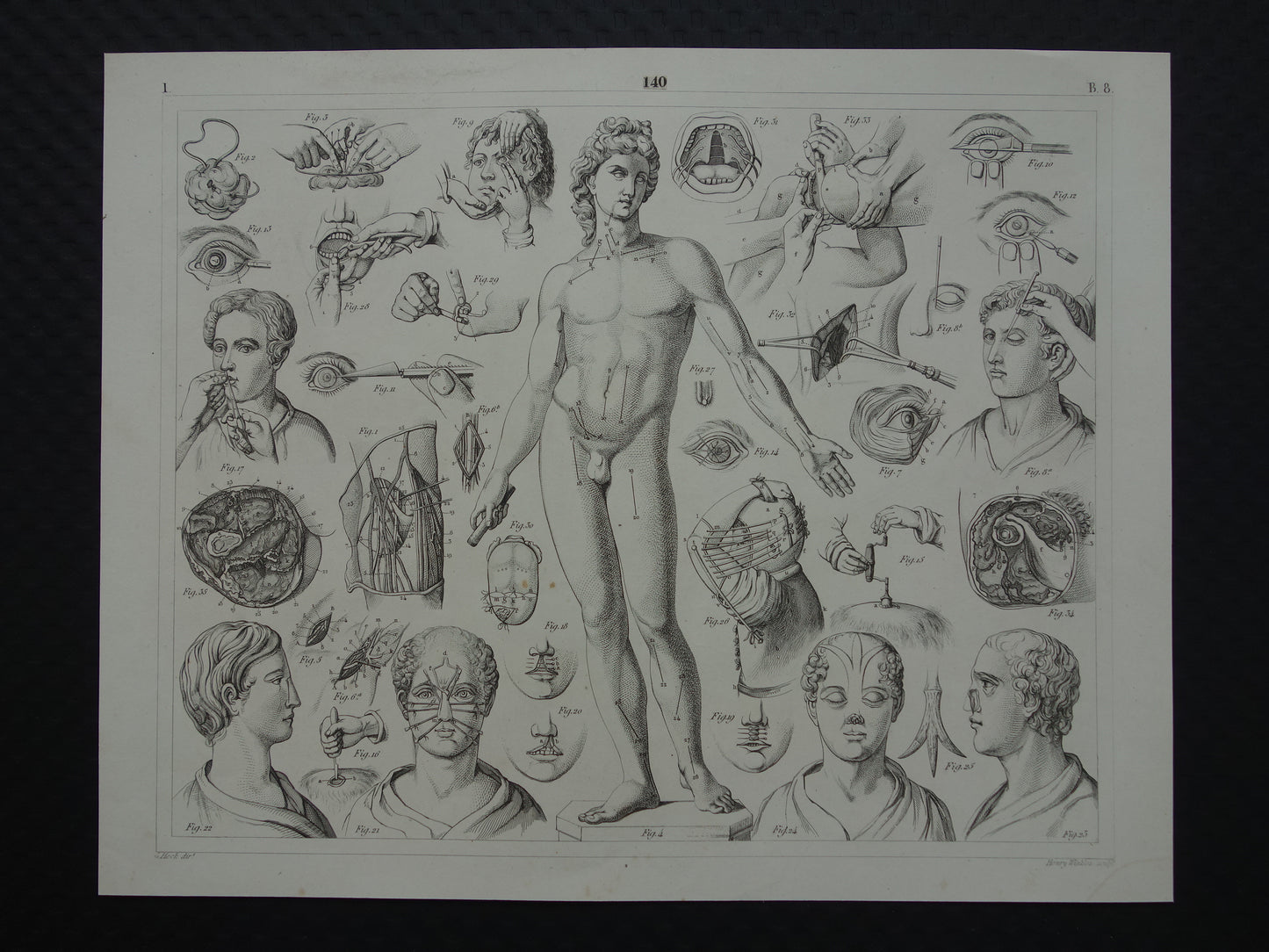 plastisch chirurgie antieke prent
