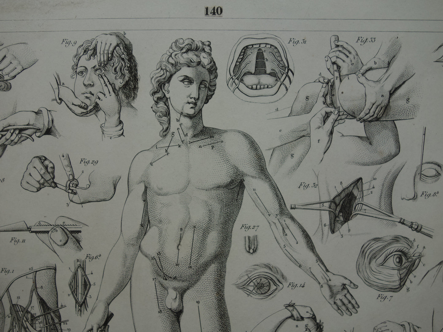 Oude anatomie prent over chirurgie originele antieke print operaties instrumenten chirurg anatomische prenten