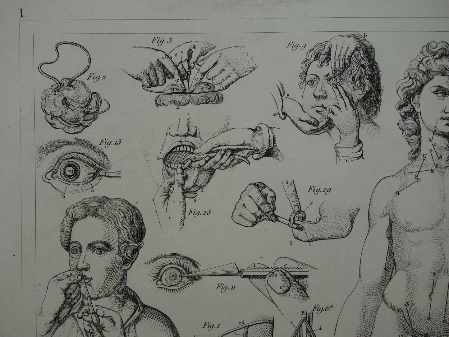 Oude anatomie prent over chirurgie originele antieke print operaties instrumenten chirurg anatomische prenten