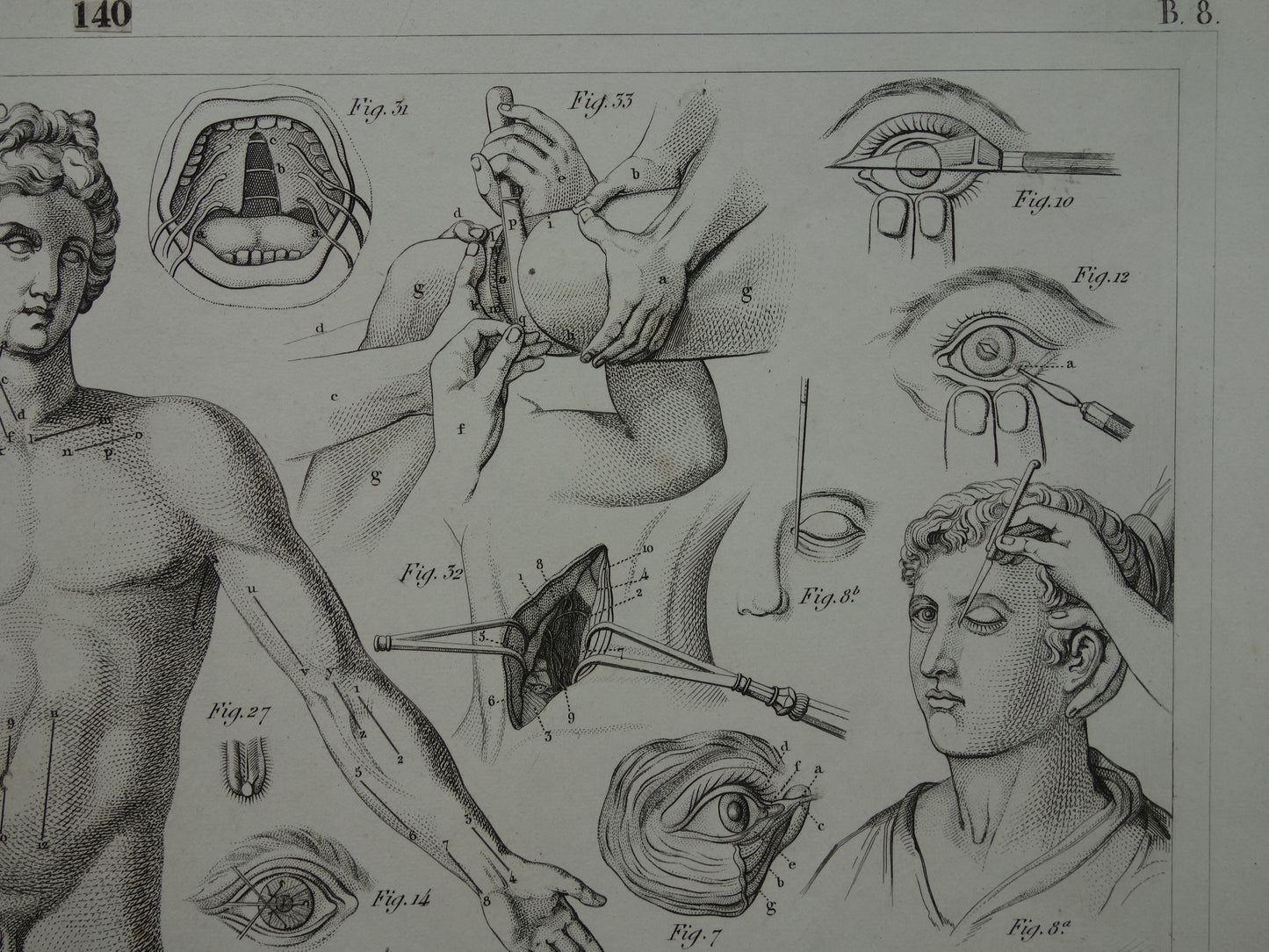 Oude anatomie prent over chirurgie originele antieke print operaties instrumenten chirurg anatomische prenten