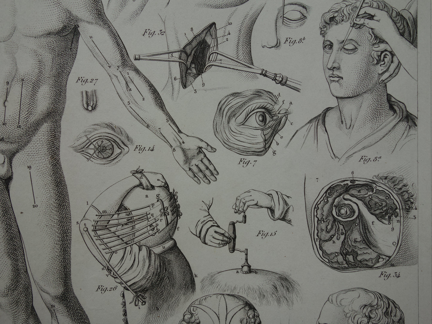 Oude anatomie prent over chirurgie originele antieke print operaties instrumenten chirurg anatomische prenten