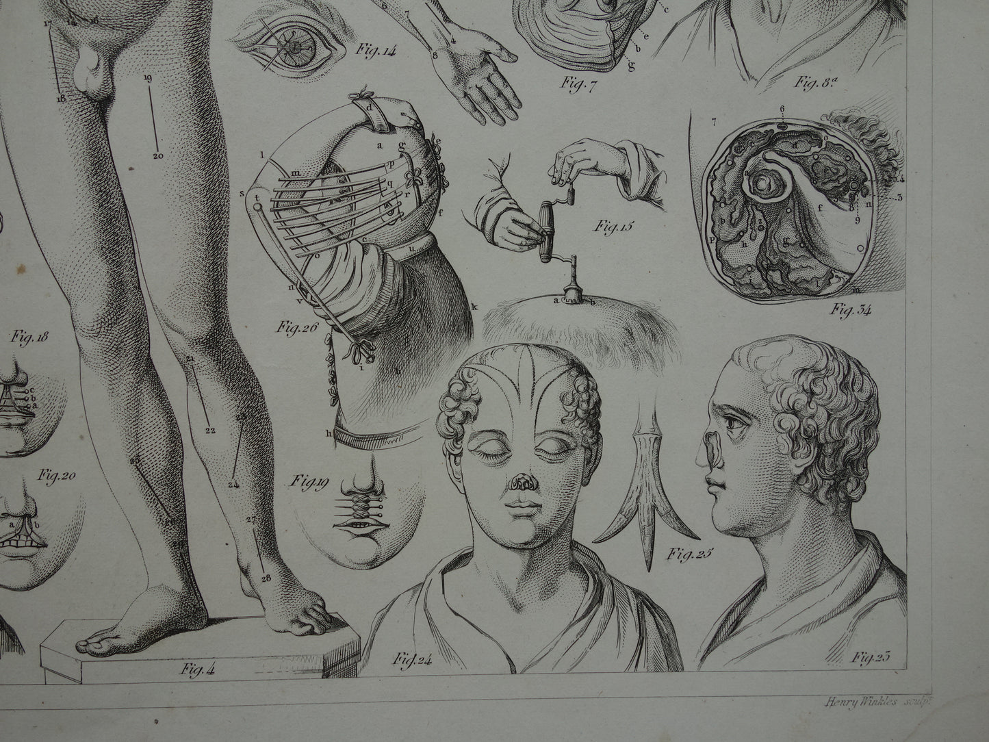 Oude anatomie prent over chirurgie originele antieke print operaties instrumenten chirurg anatomische prenten